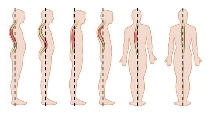 poremećaji držanja kao uzrok torakalne osteohondroze