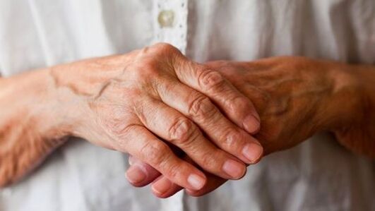 Reumatoidni artritis uzrokuje bol i oticanje zglobova prstiju. 