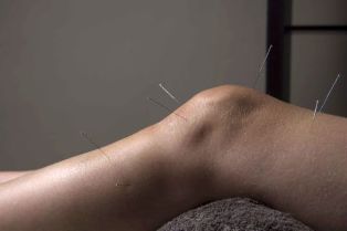 Akupunktura potiče popravak zglobnog tkiva