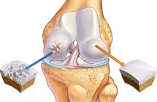 uzroci artroze zgloba koljena